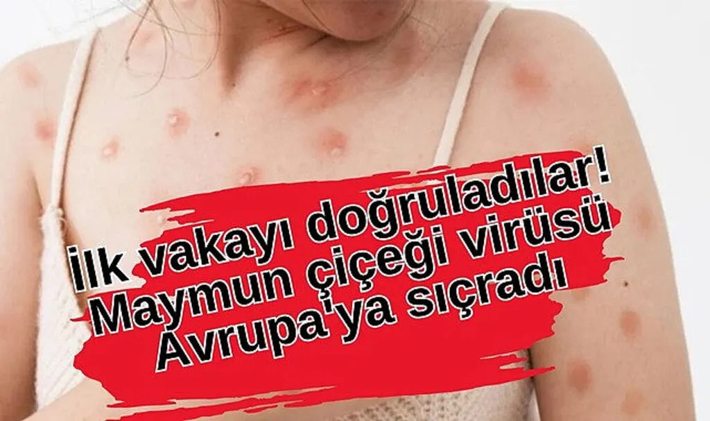 Maymun çiçeği virüsü Avrupa'da o ülke de görüldü!