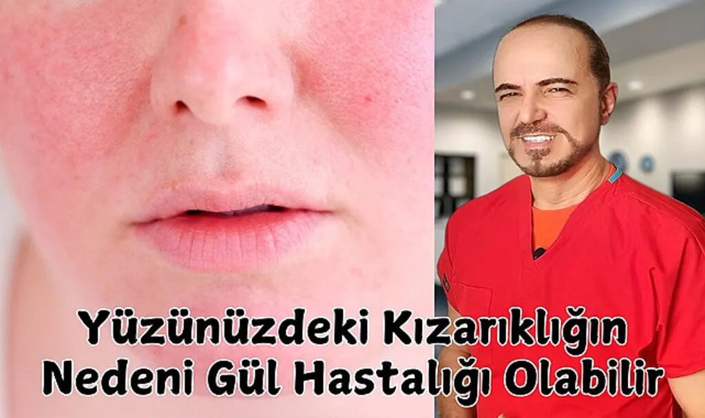 Gül Hastalığı nedir? Gül Hastalığı belirtileri ve tedavisi!