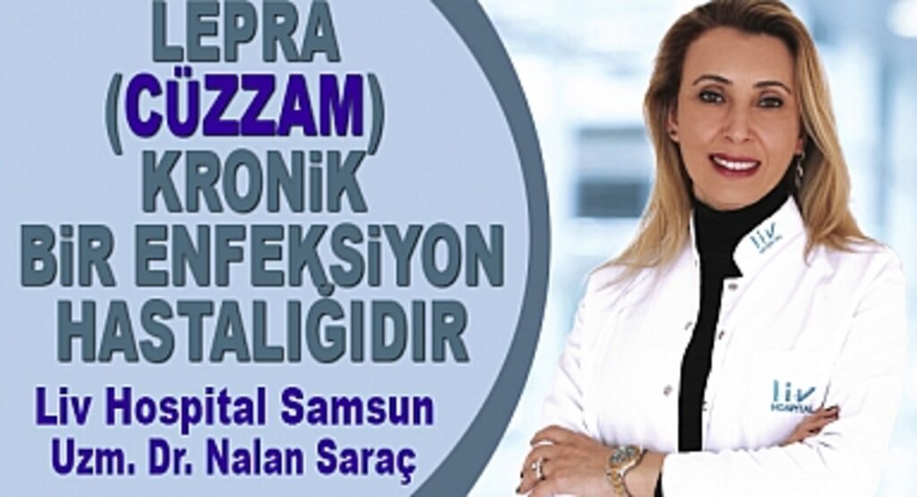 Lepra Cüzzam Hastalığı Nedir Tedavisi Nasıl olur?