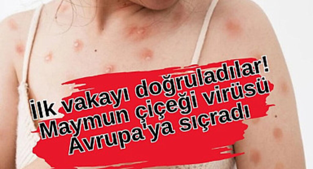 Maymun çiçeği virüsü Avrupa'da o ülke de görüldü!