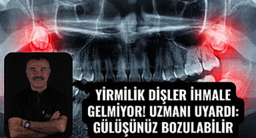 Uzman Diş Hekimi Dr. Ümit Sait Yavuz: Yirmilik dişler ne zaman çekilmeli
