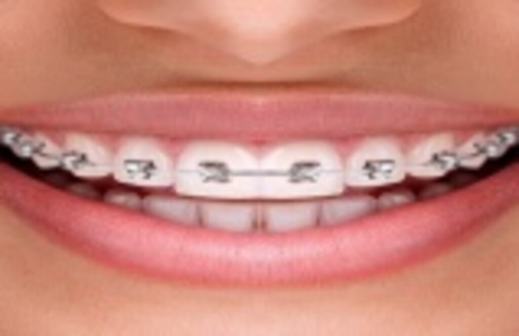 Diş teli tedavisinde süreç nasıl işliyor? Diş teli fiyatları