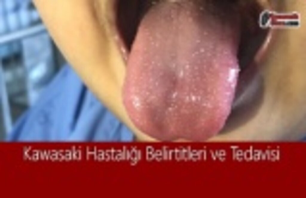 Kawasaki Hastalığı Belirtitleri ve Tedavisi