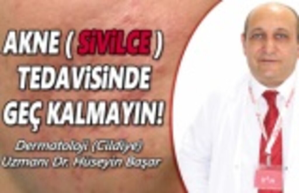 Akne sivilce tedavisine geç kalmayın!