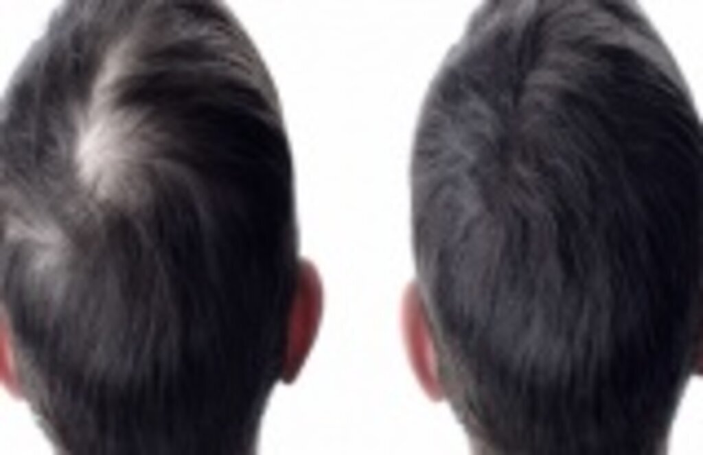 Saç Ekiminden Sonra Dikkat Edilmesi Gerekenler Nelerdir?