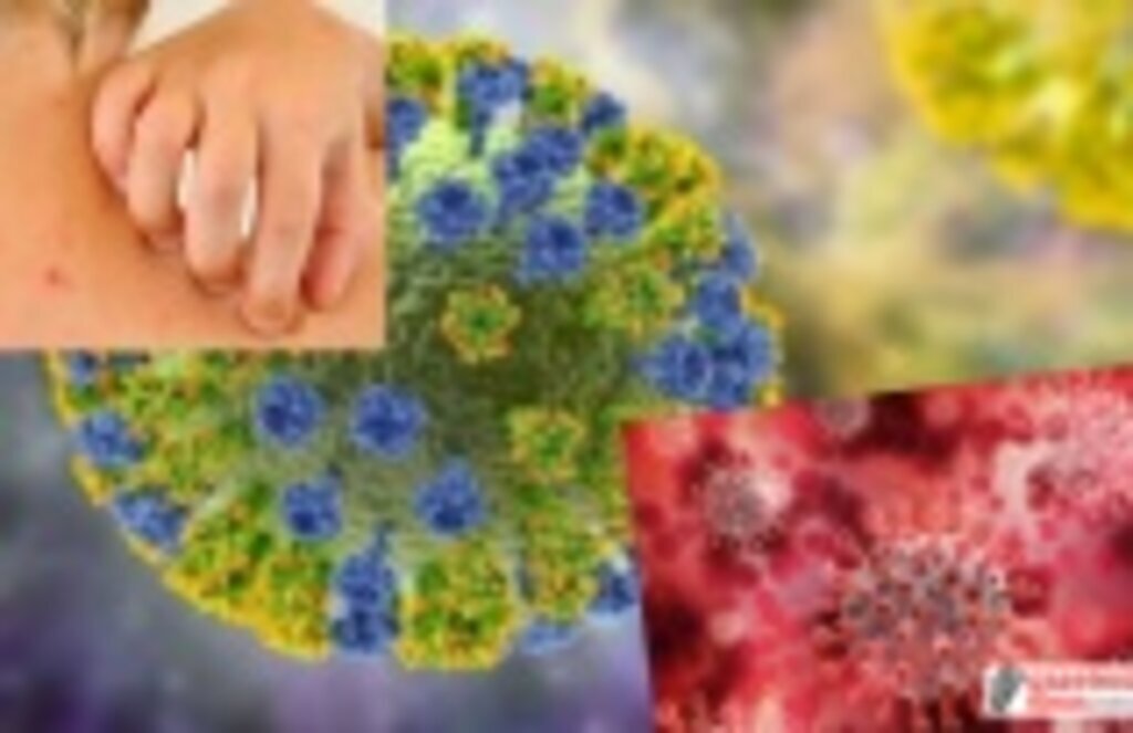 Maymun çiçeği virüsü Monkeypox hakkında bilmeniz gerekenler!