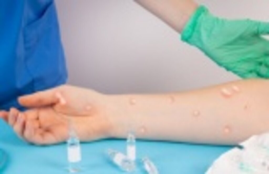 Maymun çiçeği döküntüsü alerjik döküntü ile karışır mı?