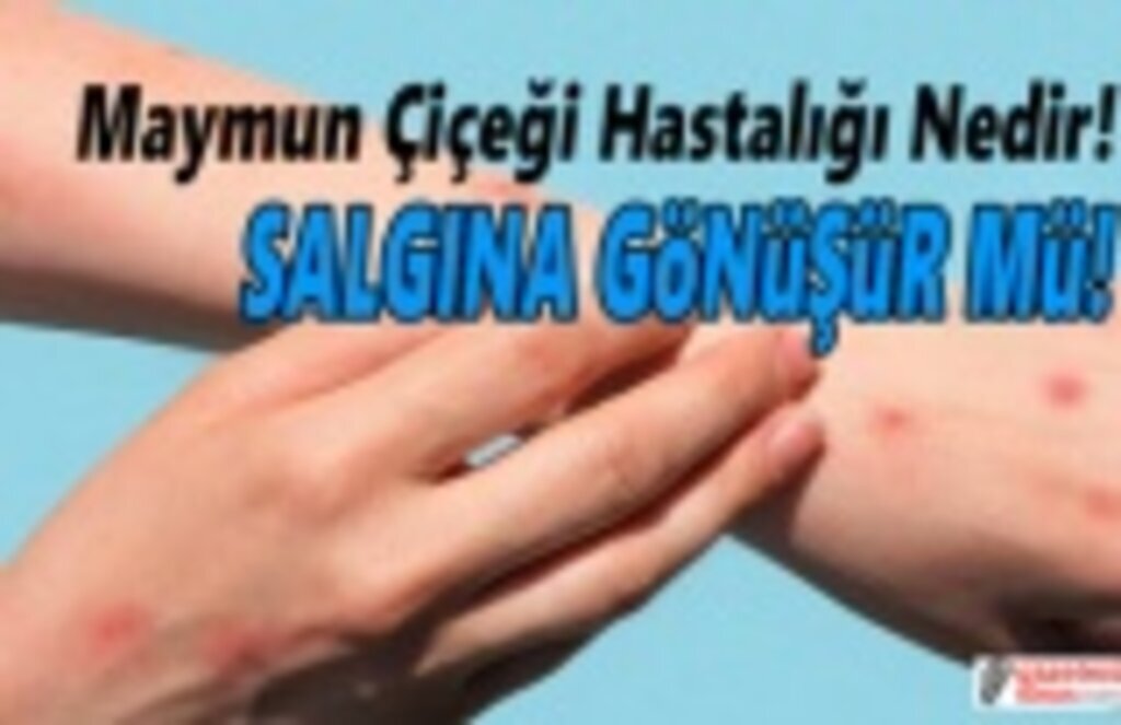 Maymun çiçeği Hastalığı Nedir pandemiye dönüşür mü?