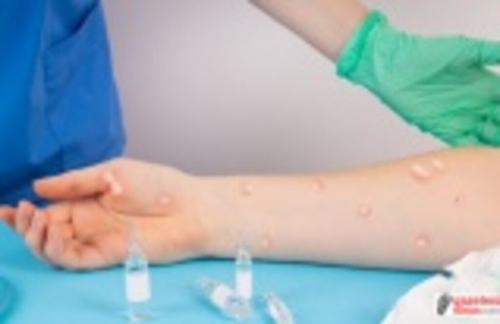 Bakan Koca açıkladı, Türkiye'de maymun çiçeği vakaları artıyor