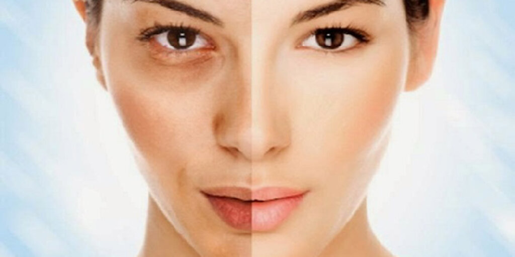 Açık tenlilerde güneş lekesi oluşma ihtimali daha yüksek