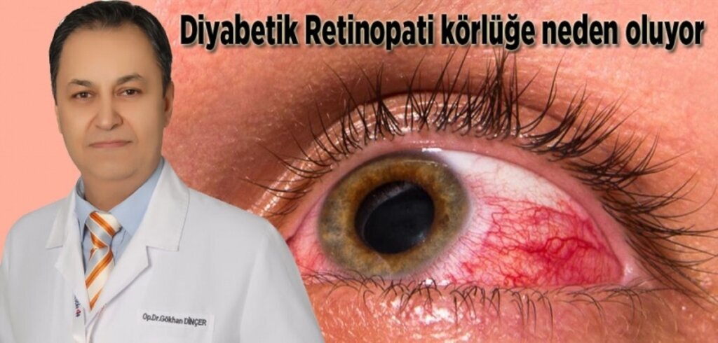 Büyük Anadolu Hastanesi'nden 'Diyabetik Retinopati' uyarısı