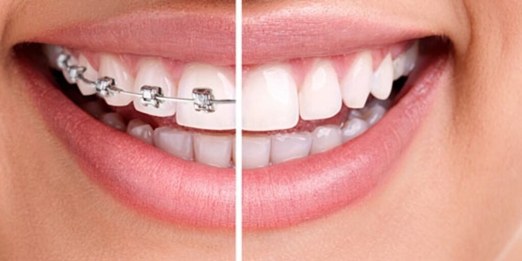 Diş teli ile ilgili 5 önemli bilgi