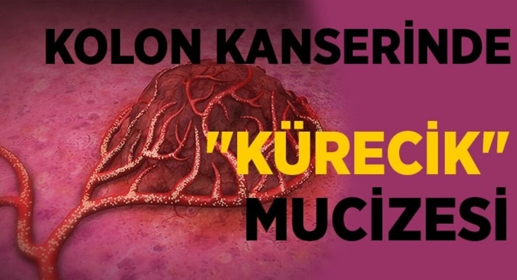 Kolon kanserinde 'kürecik' mucizesi