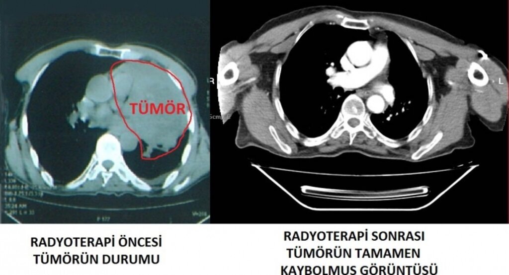 Radyoterapi tedavisiyle akciğer tümöründen tamamen kurtuldu