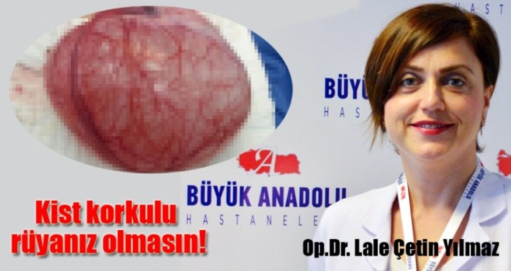 Şikayet yaratan kistten Büyük Anadolu Hastaneleri'nde kurtuldu