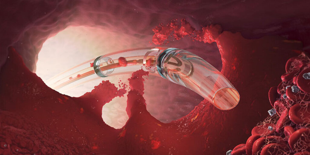 Toplardamarda pıhtılaşmaya etkili çözüm 